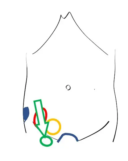 大腿ヘルニアの位置を示すイラスト