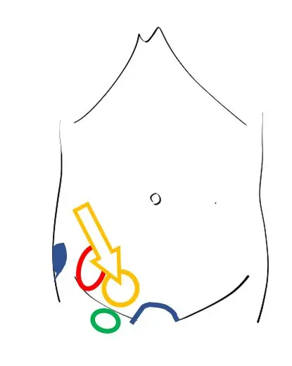 内鼠径ヘルニアの位置を示すイラスト