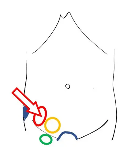 外鼠径ヘルニアの位置を示すイラスト